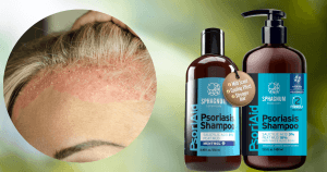 Close-up of psoriasis on the scalp with two PsoriAid Peat Mud Shampoo bottles by Sphagnum Botanicals—3% salicylic acid and menthol formula for sensitive scalps.